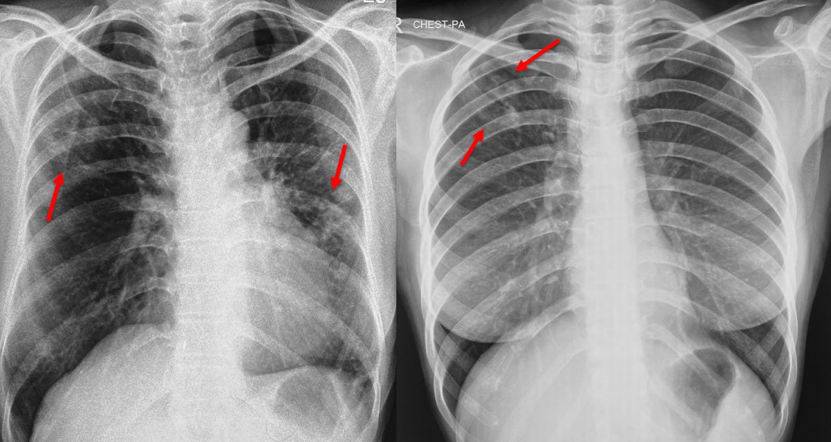 Chest Xray for Screening for Tuberculosis